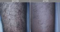 Chicago Laser Hair Removal